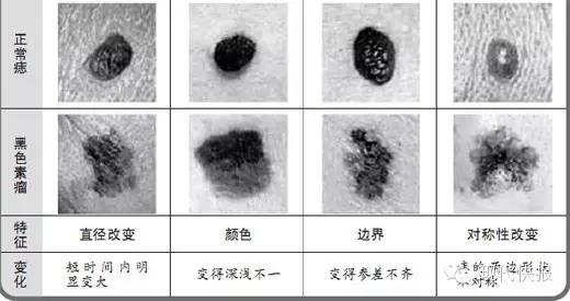 女子腳上黑痣成了惡性瘤，只因常做這件事……身上有痣的要看！